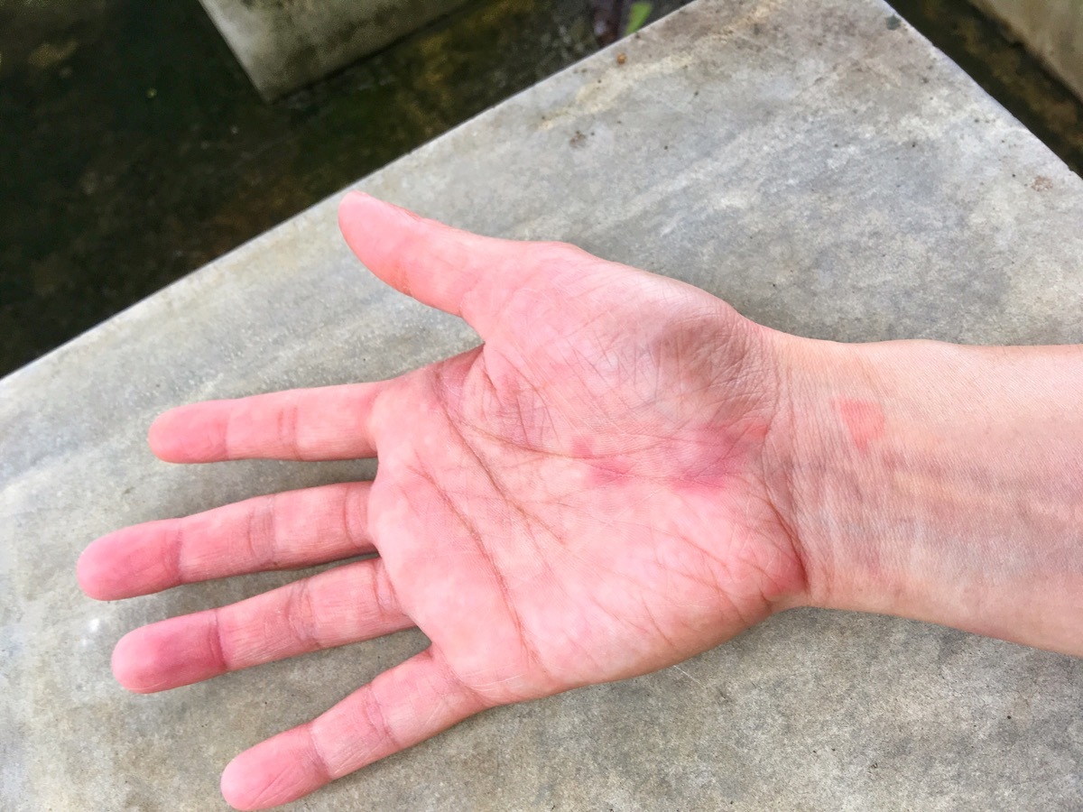 lupus-hand