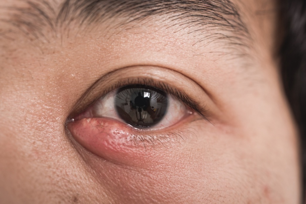 Woman with a stye on her eye