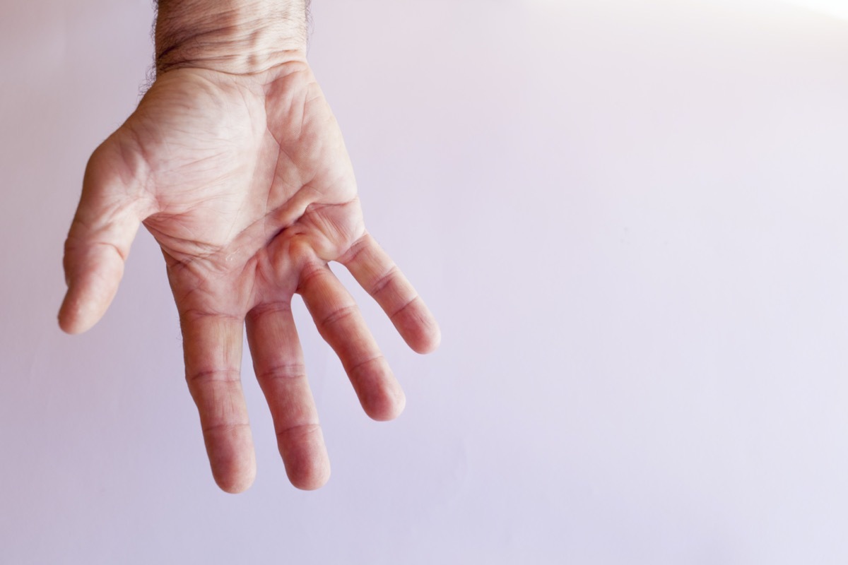 Hand of an man with Dupuytren contracture disease