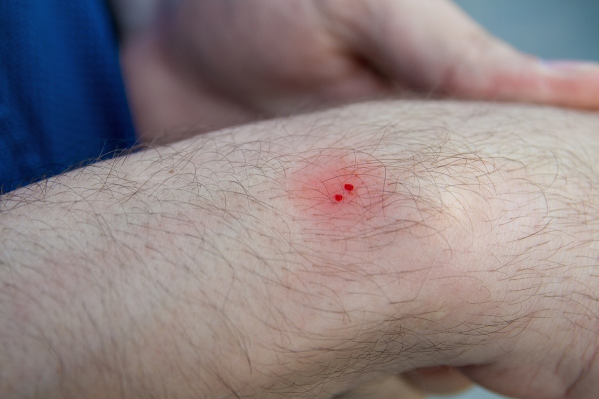 Male hand with the wound from snake bite or snakebite. Bite marks with blood drops and red skin. Closeup, selective focus