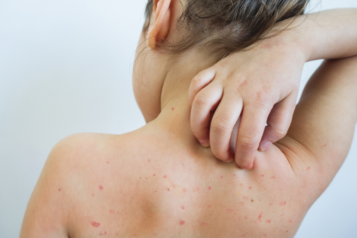 Young girl with rash