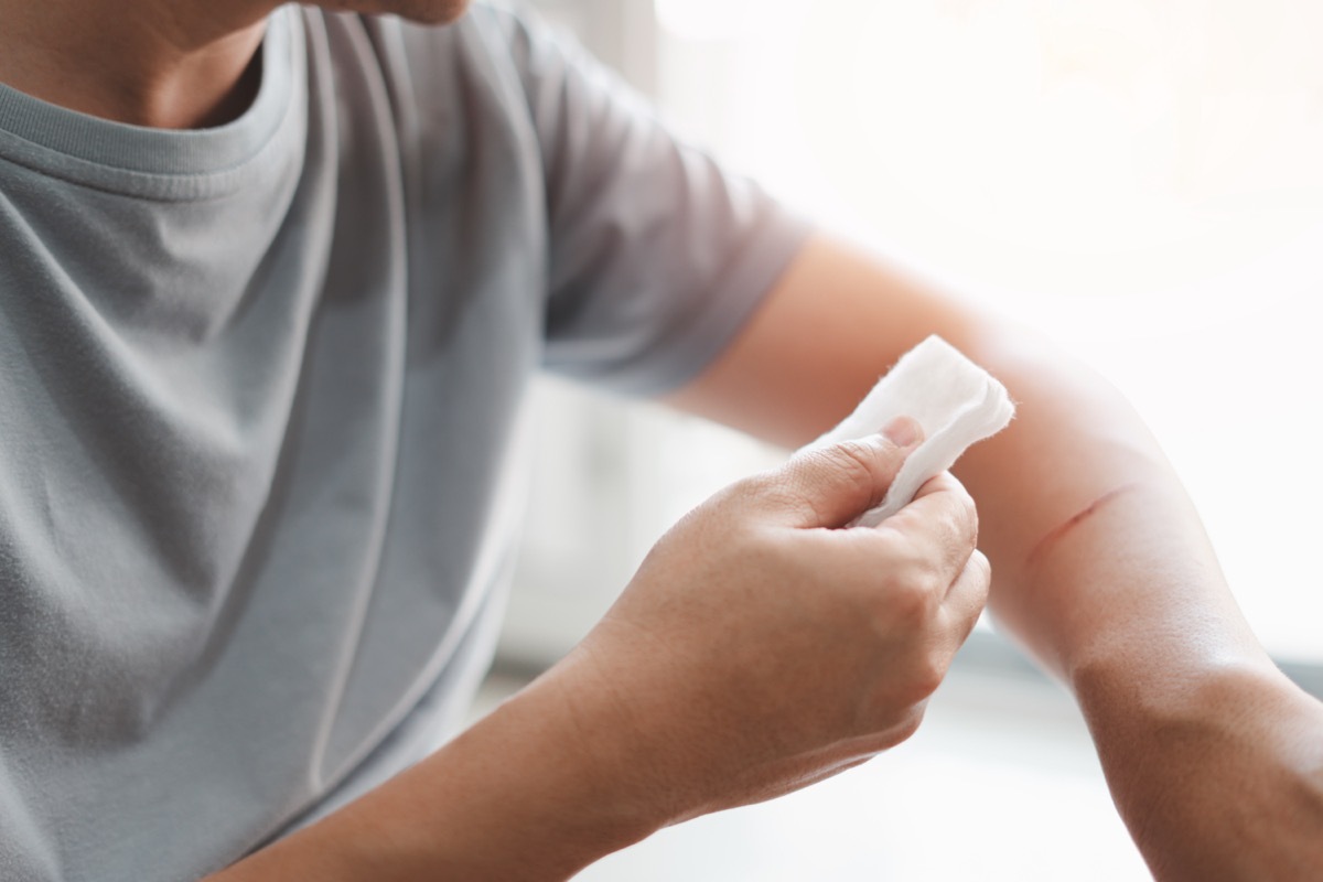 A man use medical cotton swab for cleaning and disinfection of wounds Cat scratch in First aid concept bleeding wound.