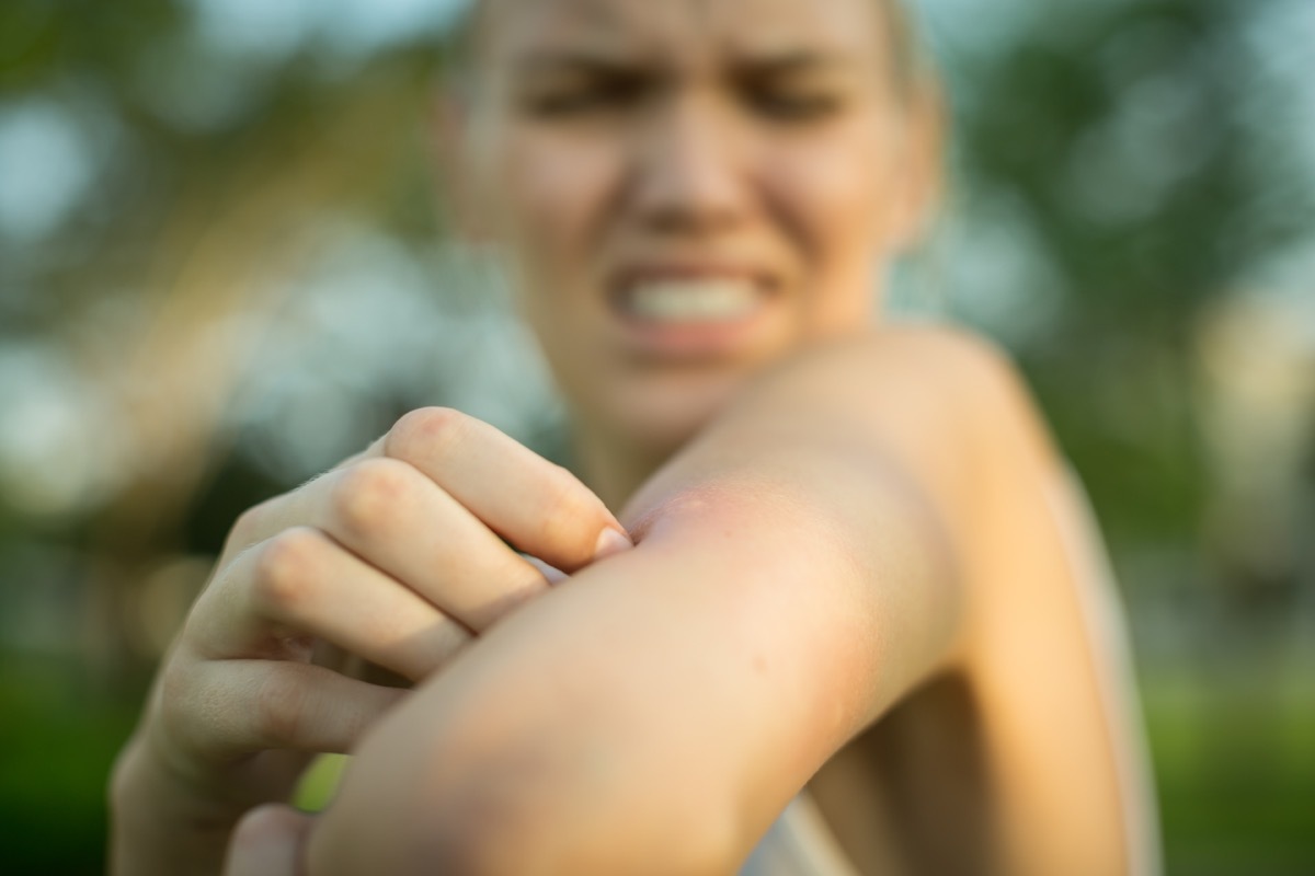 close up of a red mosquito bite on a person's arm, rubbing and scratching it outdoor in the park.