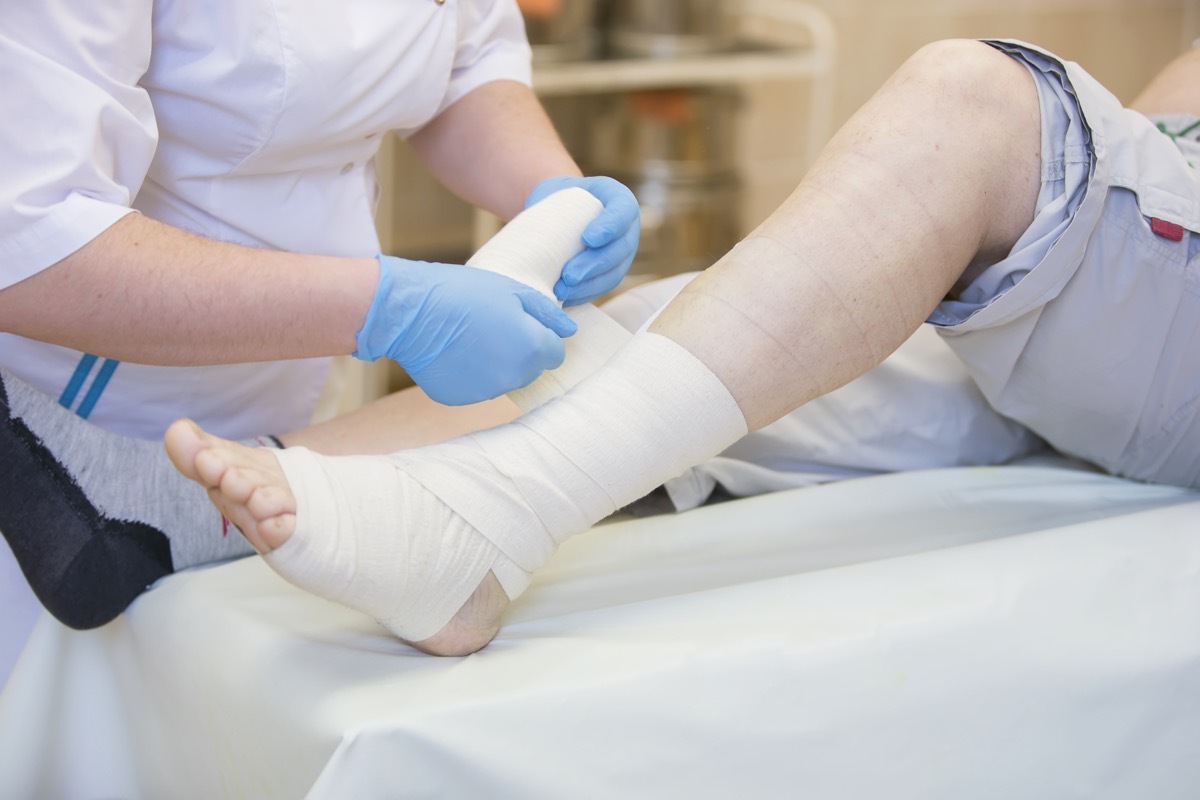 Nurse bandages the leg. Fracture of human lower limbs. Treatment of broken bones. Impose a gypsum. Patient surgical department. The doctor's hands tighten the bandage on his leg