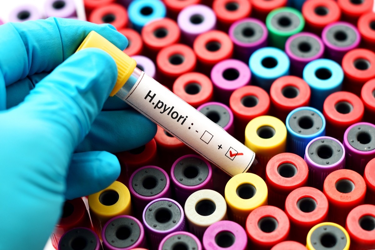 Blood sample positive H.pylori